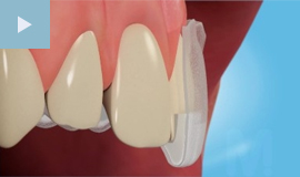 Tooth Whitening